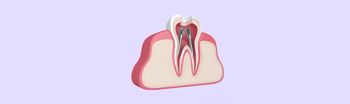 Why Root Canal Treatment Is the Best Option for You and Your Family