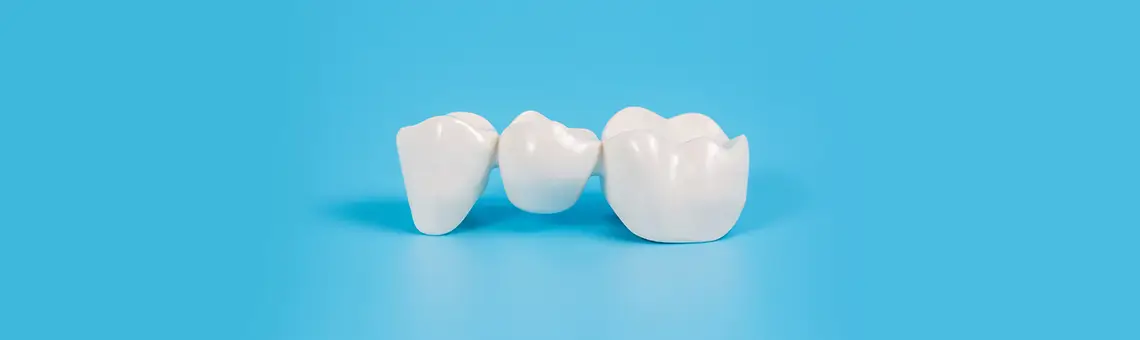 What Are Dental Bridges and Why May You Need Them