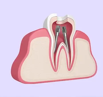 Root Canal vs Tooth Extraction: Their Advantages, and Disadvantages