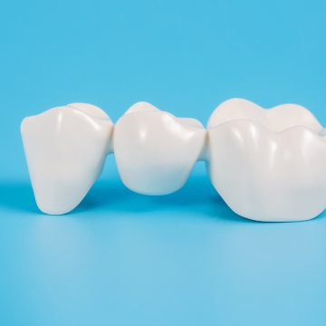 5 Pros and Cons You Should Know Before Getting Dental Bridges