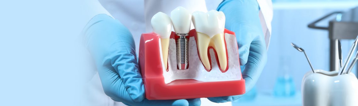 What are Dental Implants: Procedure, Benefits, and Aftercare Tips