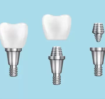 What are Dental Implants: Procedure, Benefits, and Aftercare Tips