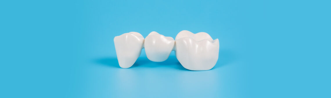 Important Aftercare Tips & Instructions for Dental Bridges