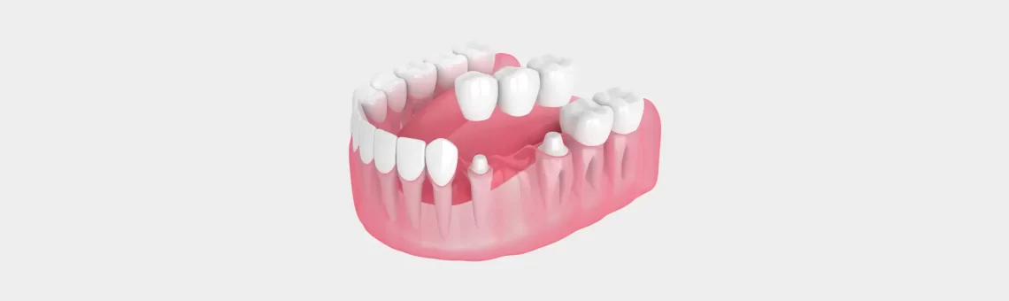 What Are Dental Bridges and How Do They Work?
