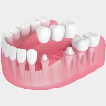 What Are Dental Bridges and How Do They Work?